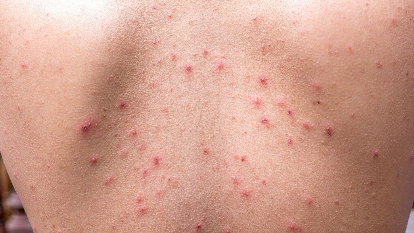 4 Common Skin Diseases and Conditions in Adults